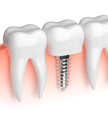 implantes-odontologicos-02
